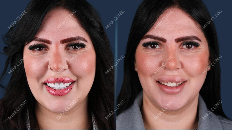 Gums before after